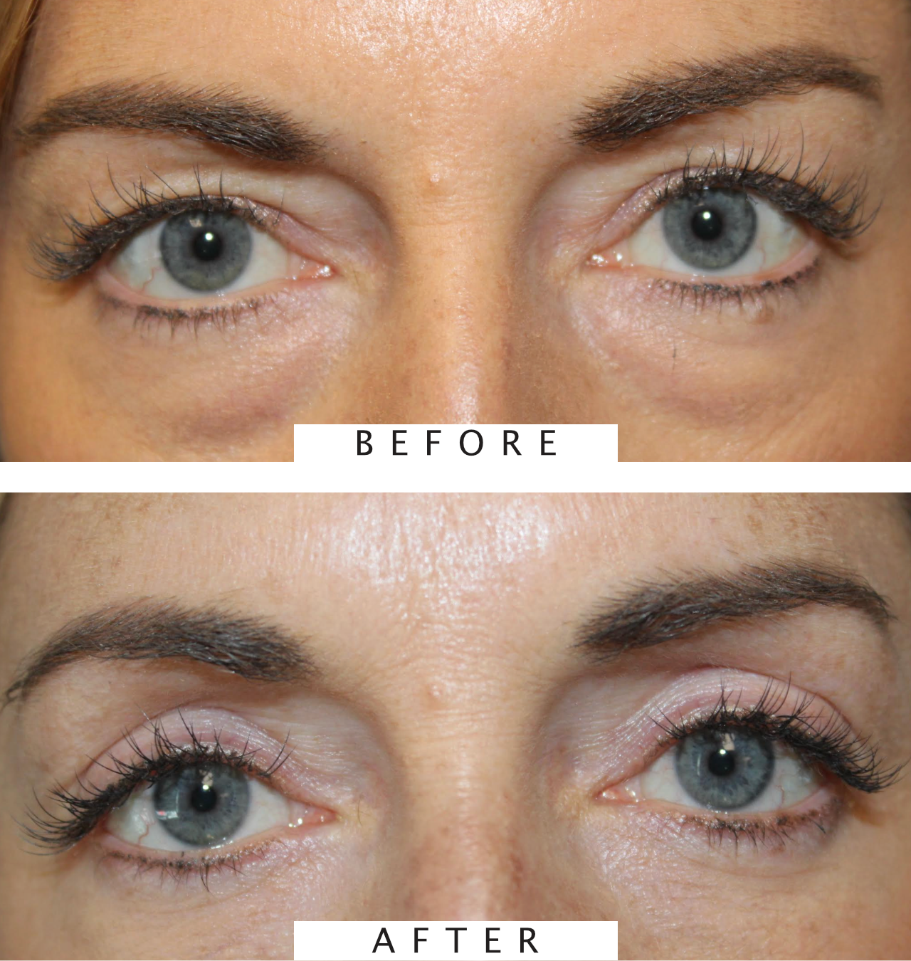 Cosmetic Upper & Lower blepharoplasty