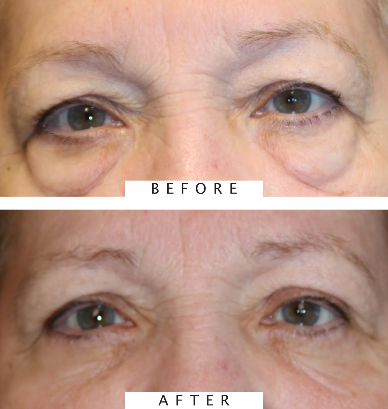 Cosmetic Lower Blepharoplasty