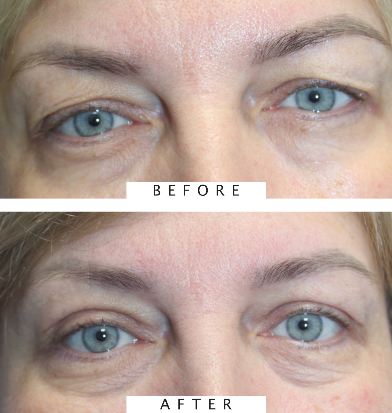 Bilateral Upper Blepharoplasty