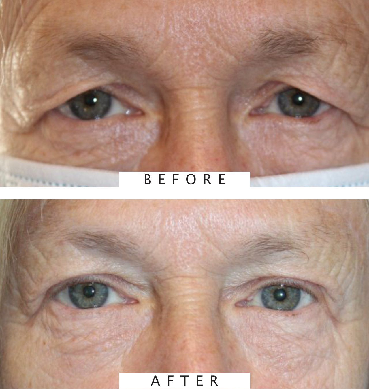Upper Blepharoplasty and Brow Lift