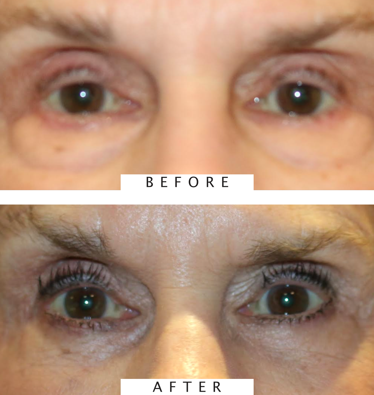 Bilateral Lower Eyelid Blepharoplasty with Chemical Peel
