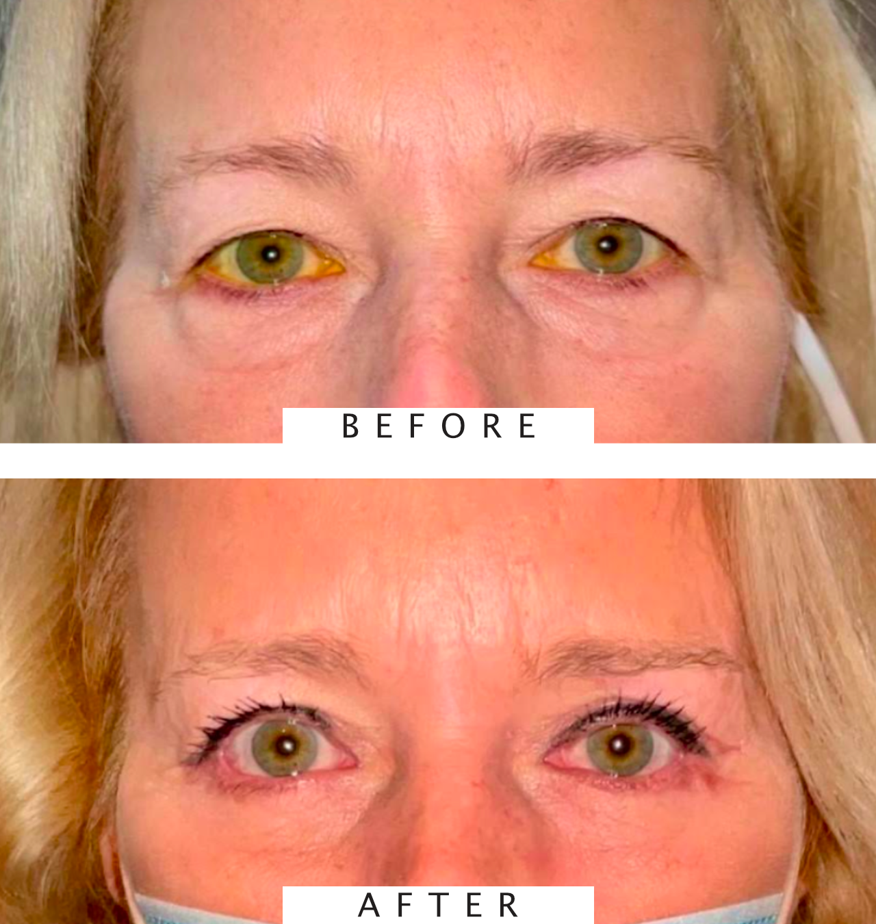Upper and Lower Eyelid Blepharoplasty