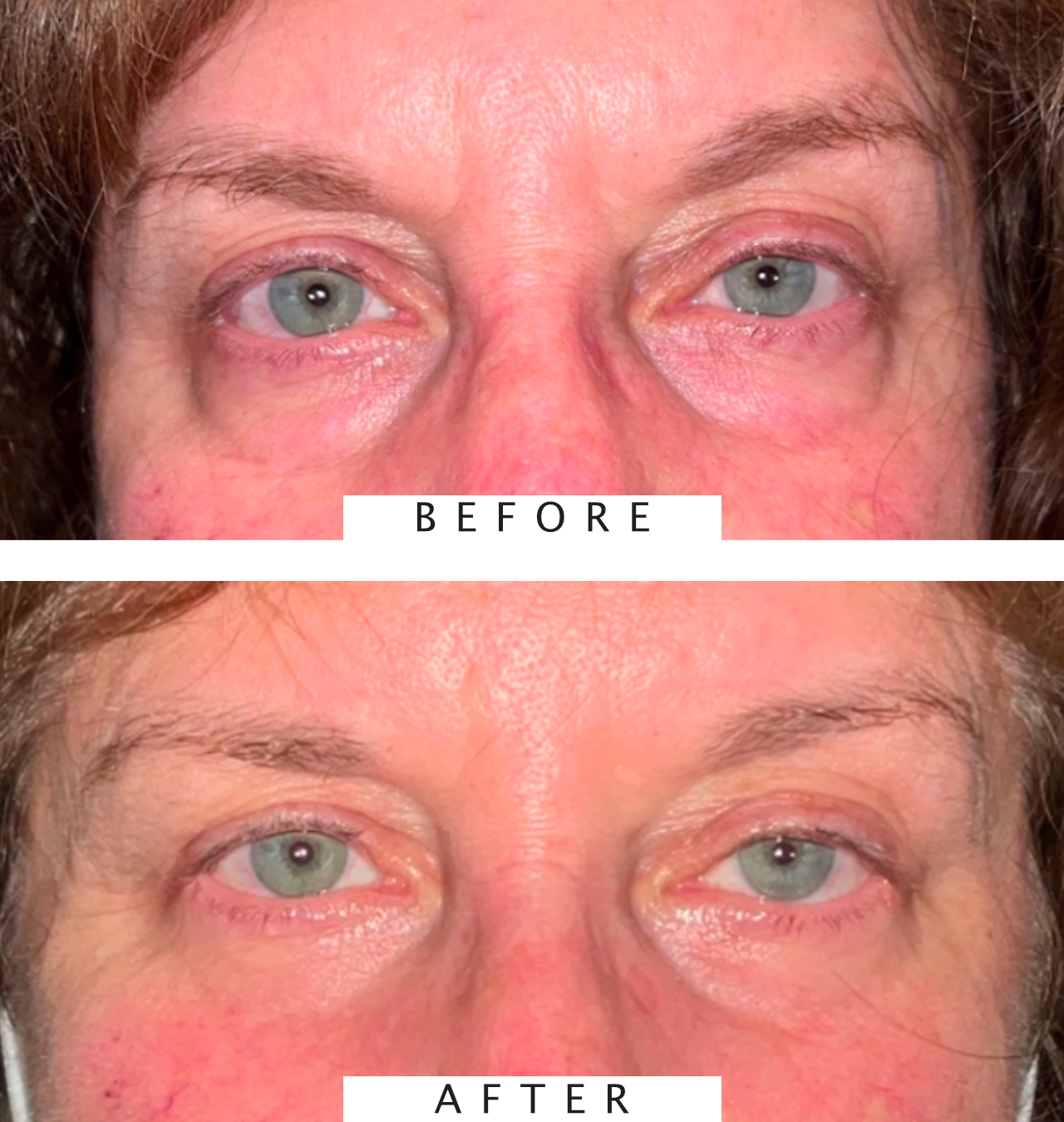 Lower Eyelid Blepharoplasty