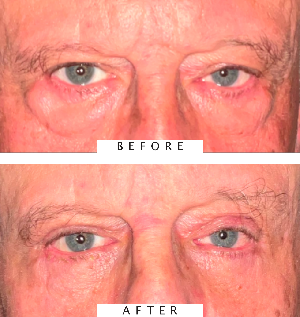 Lower Eyelid Blepharoplasty
