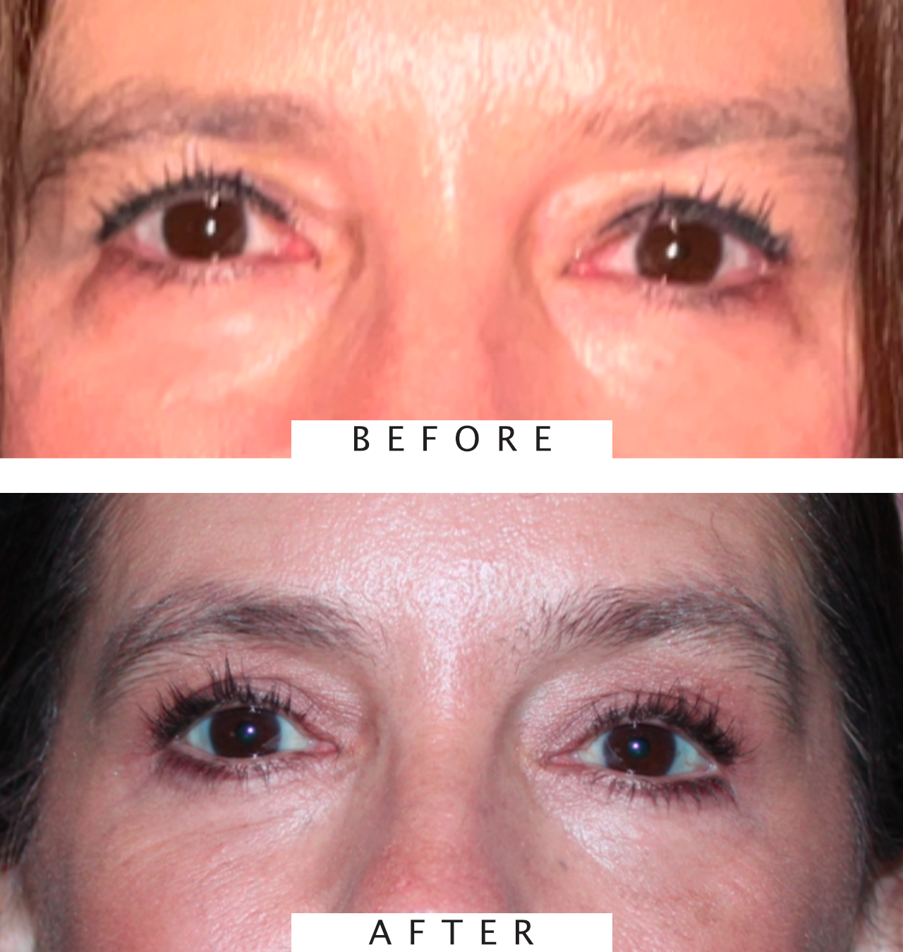 Lower Eyelid Blepharoplasty
