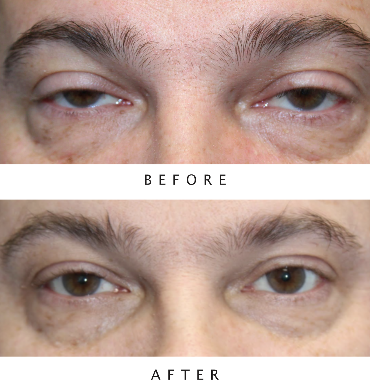 Bilateral Ptosis Repair