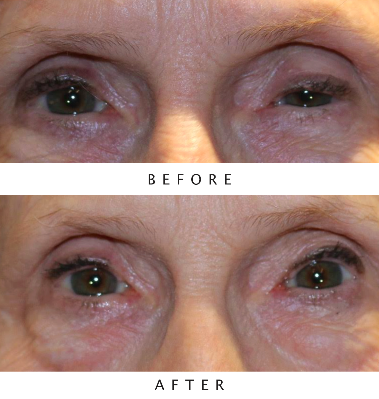 Left Upper Lid External Ptosis Repair
