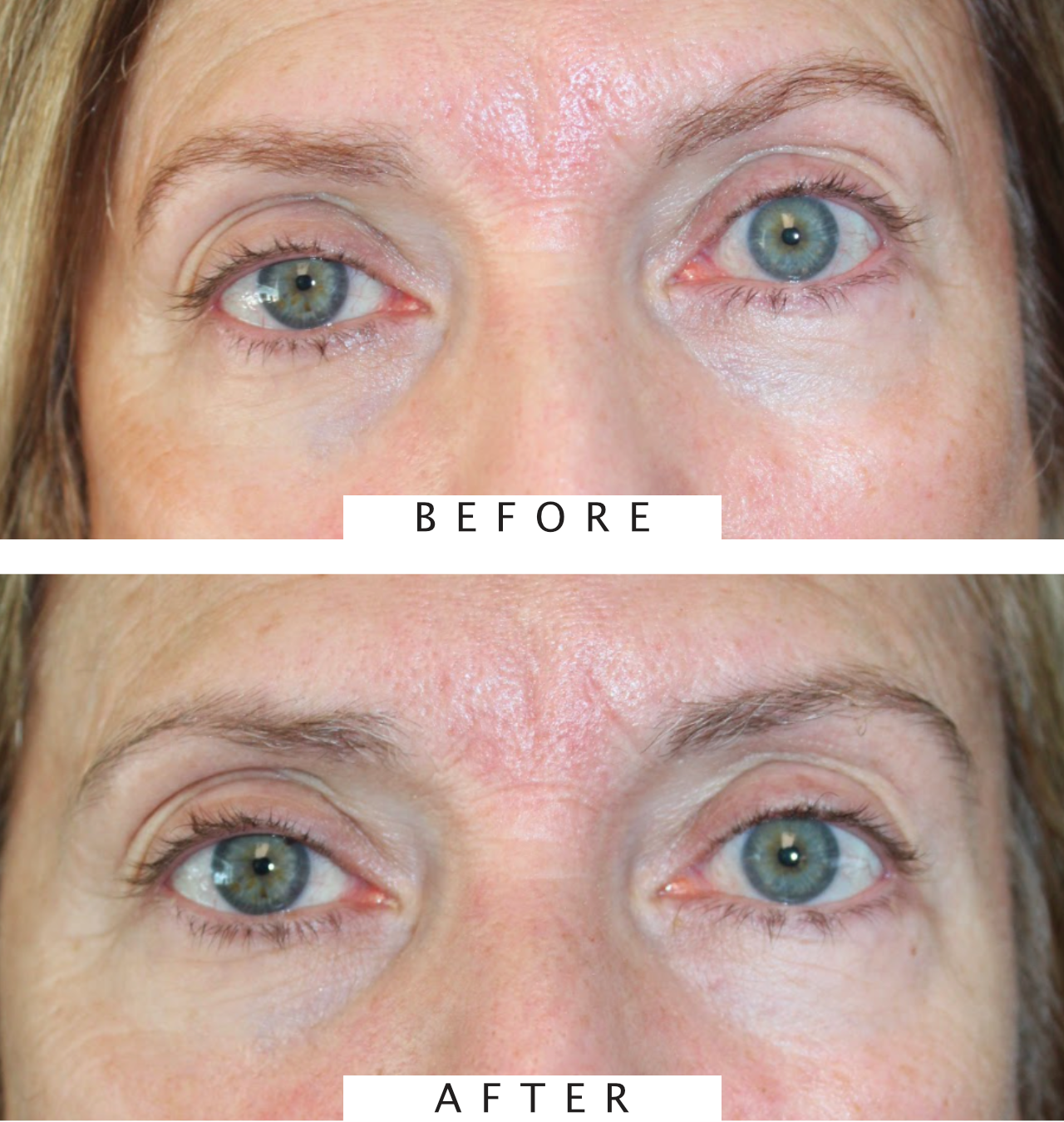 Right upper eyelid Ptosis Repair