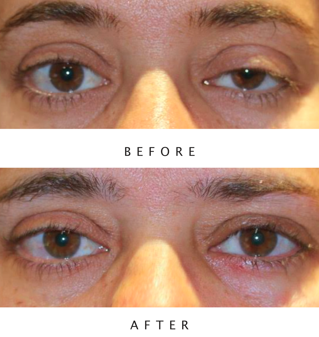 Left Upper Lid Ptosis Repair