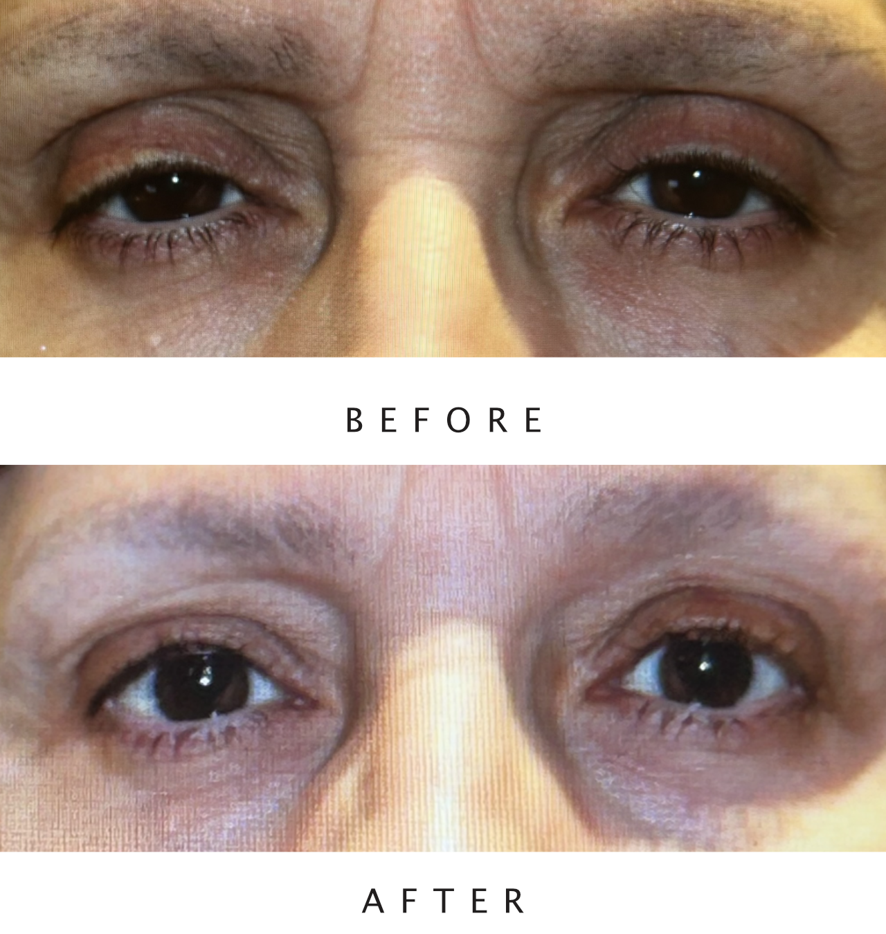 Bilateral Upper Lid Ptosis Repair