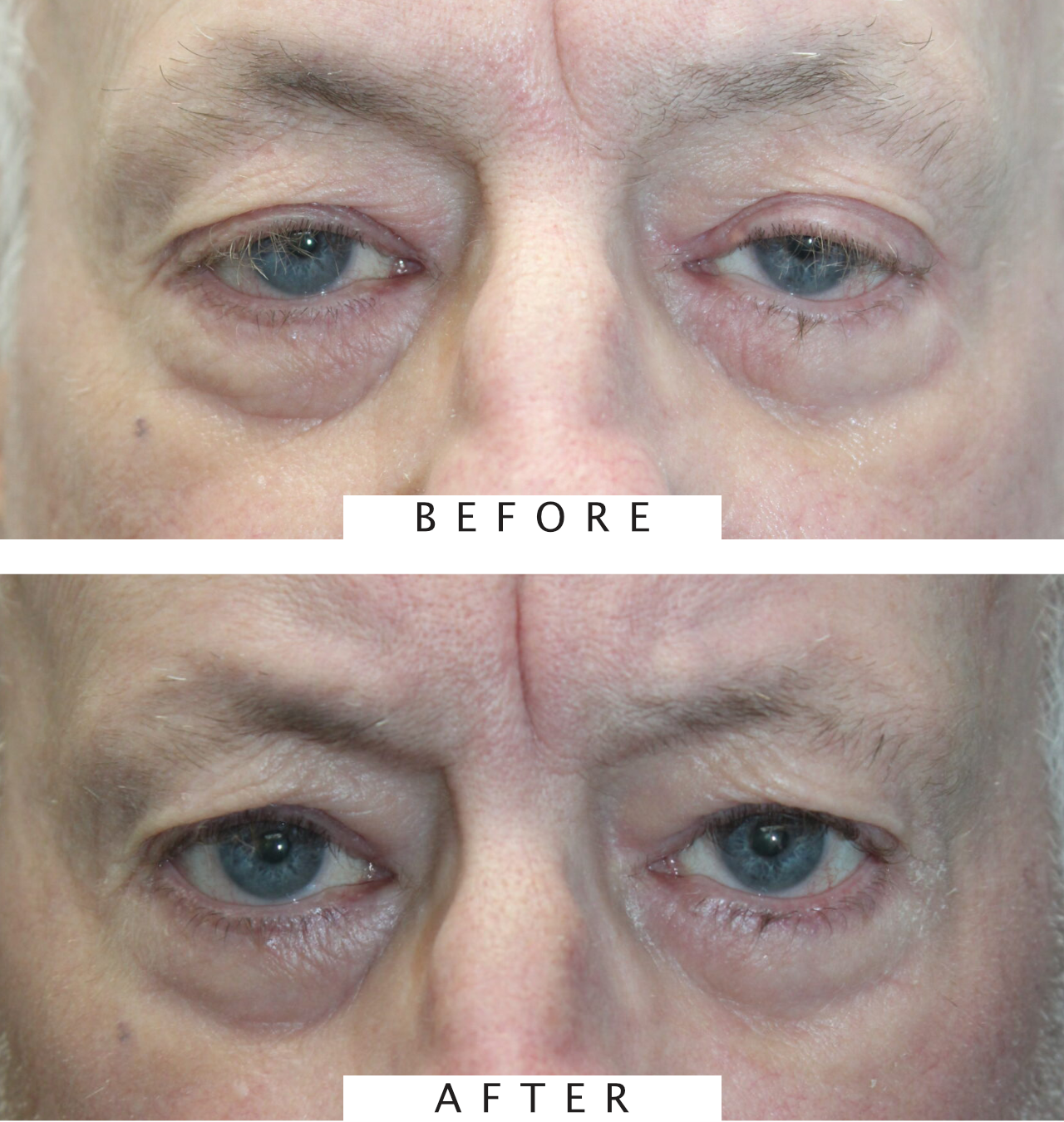 Ptosis Repair