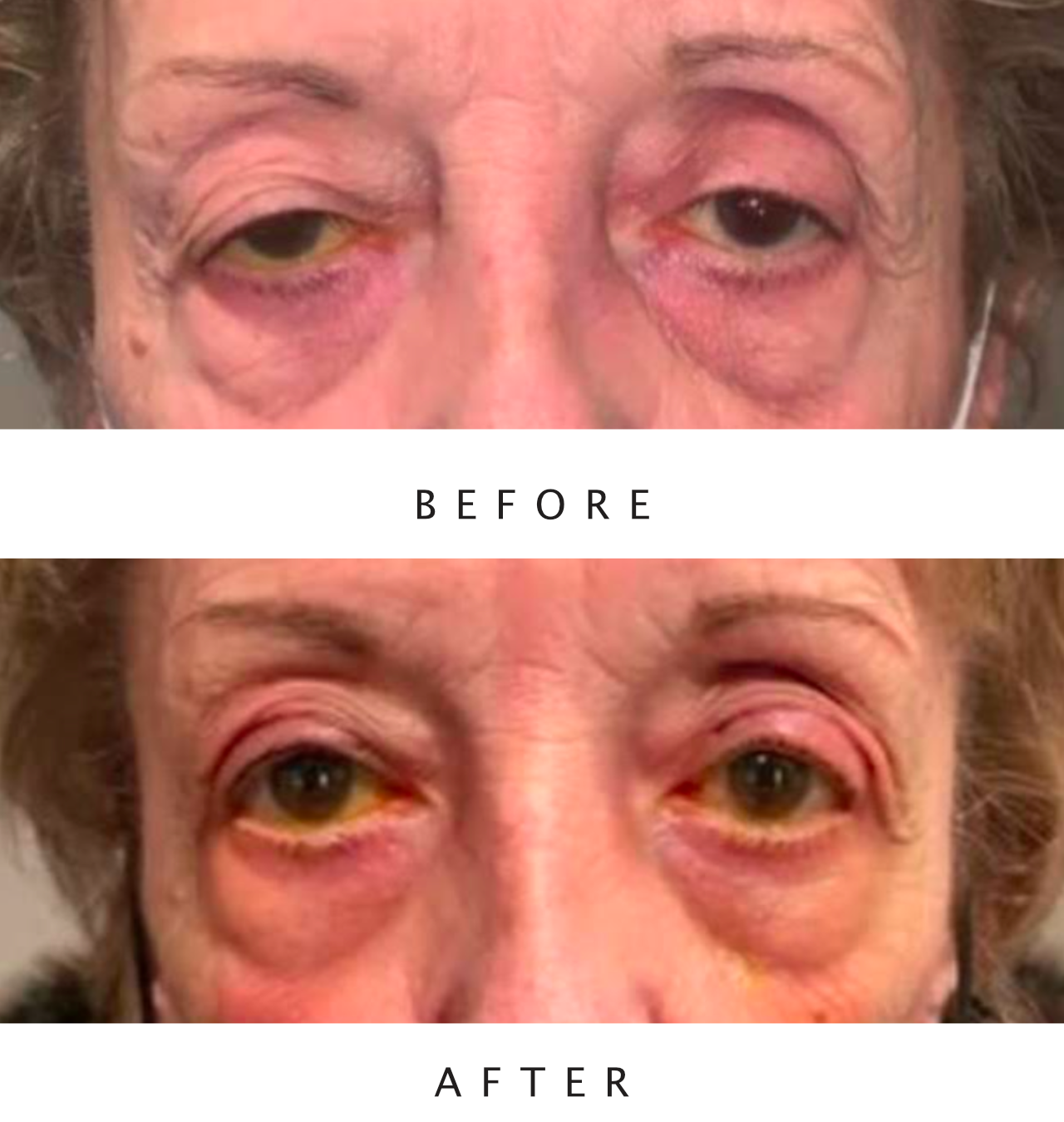 Ptosis Repair