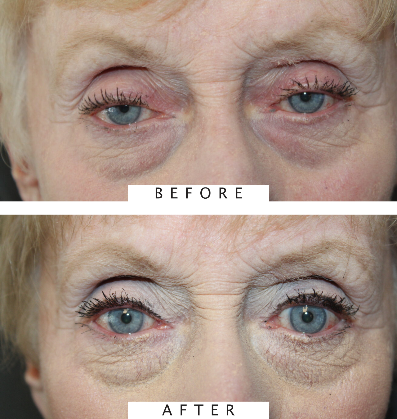 Ptosis Repair