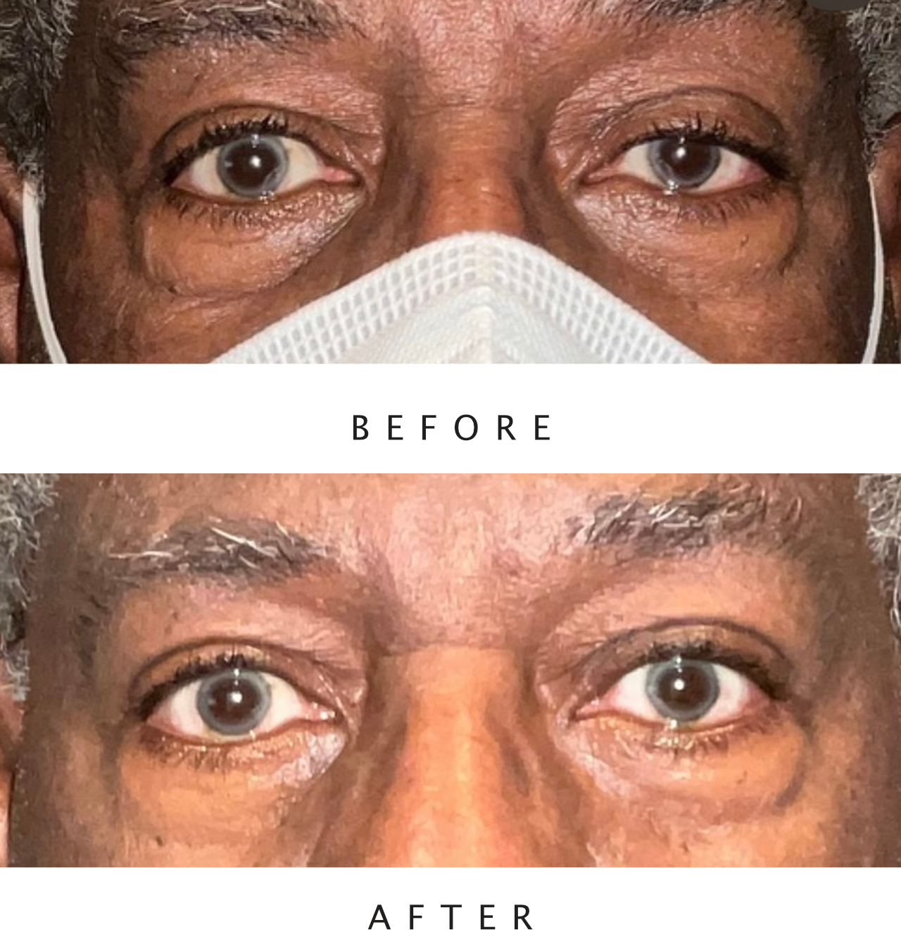 Left Ptosis Repair