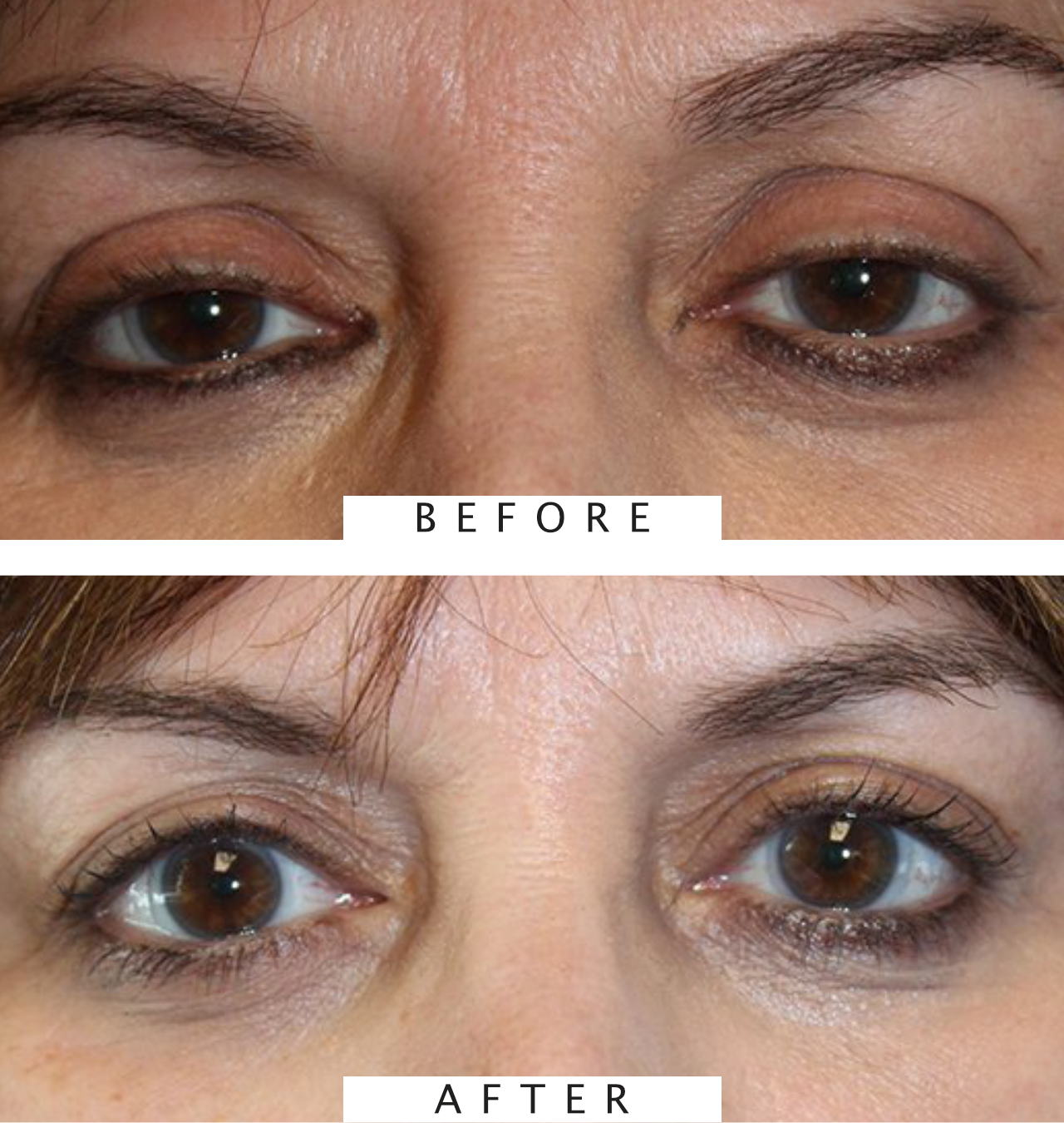 Ptosis Procedure