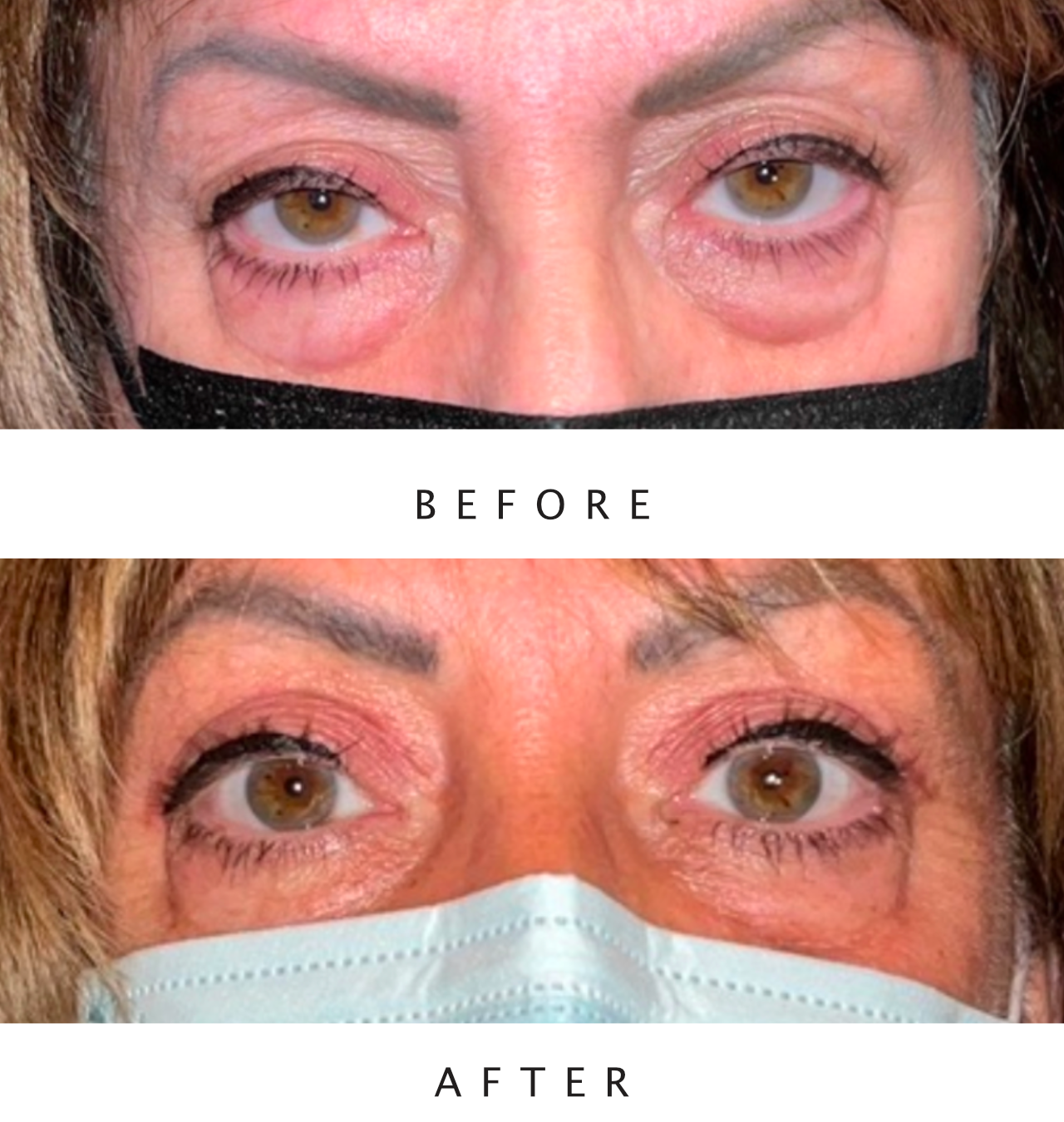 Bilateral Upper Ptosis Repair