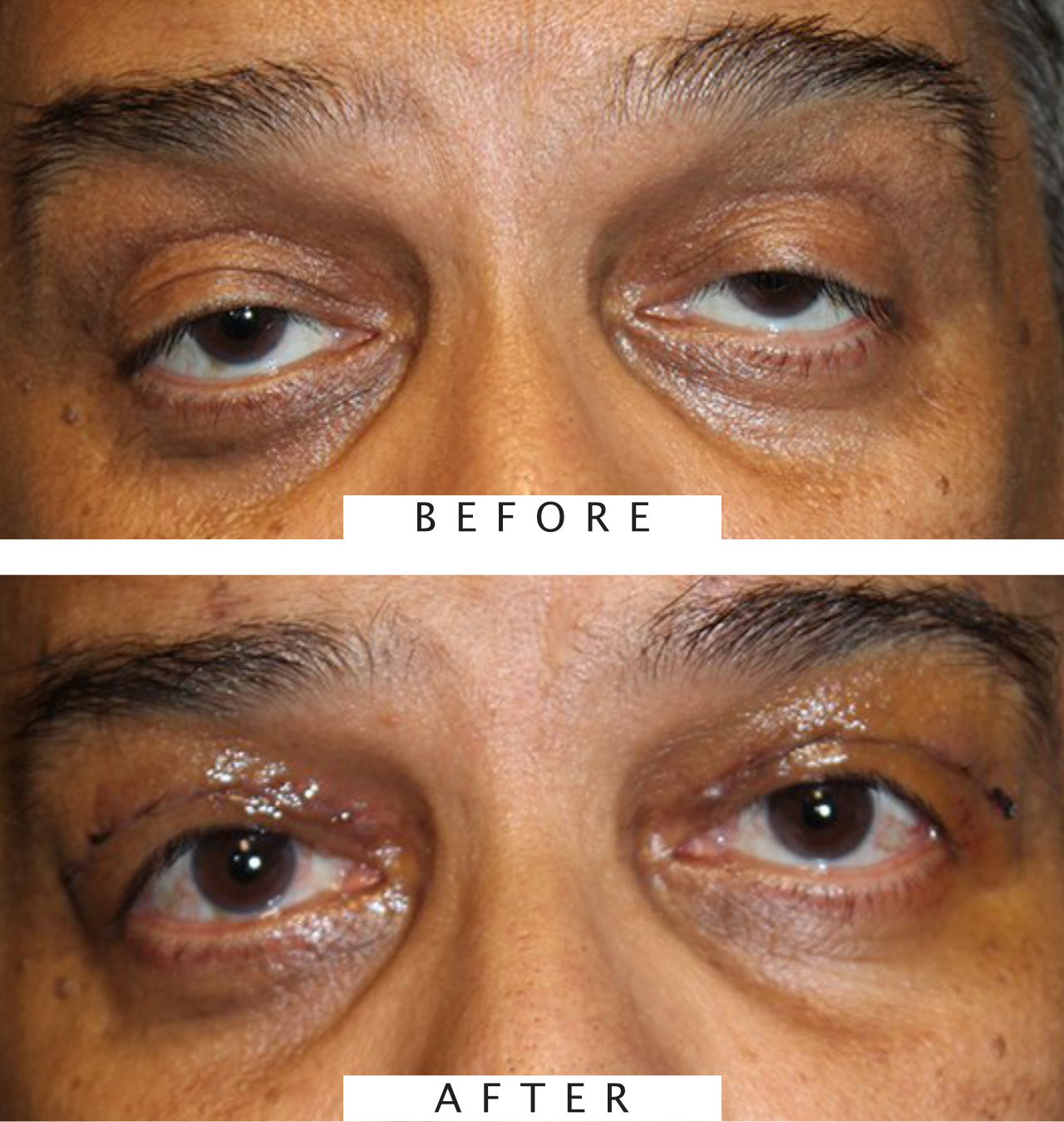 Ptosis Procedure