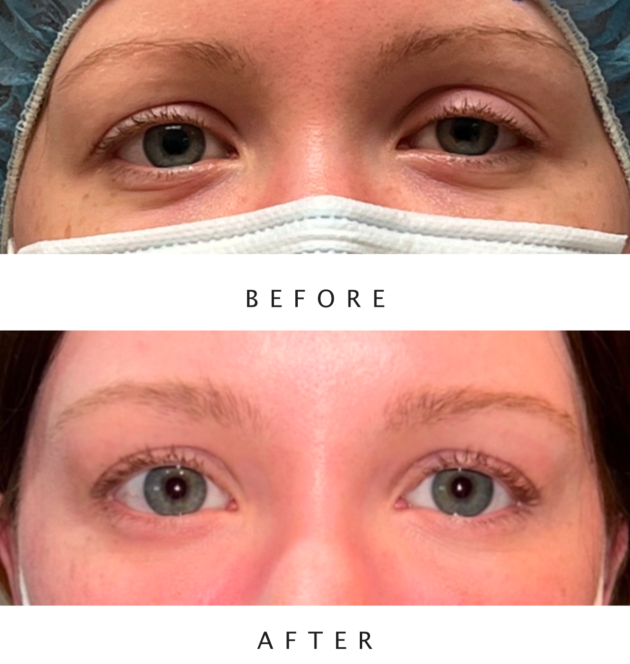 Left Ptosis Repair