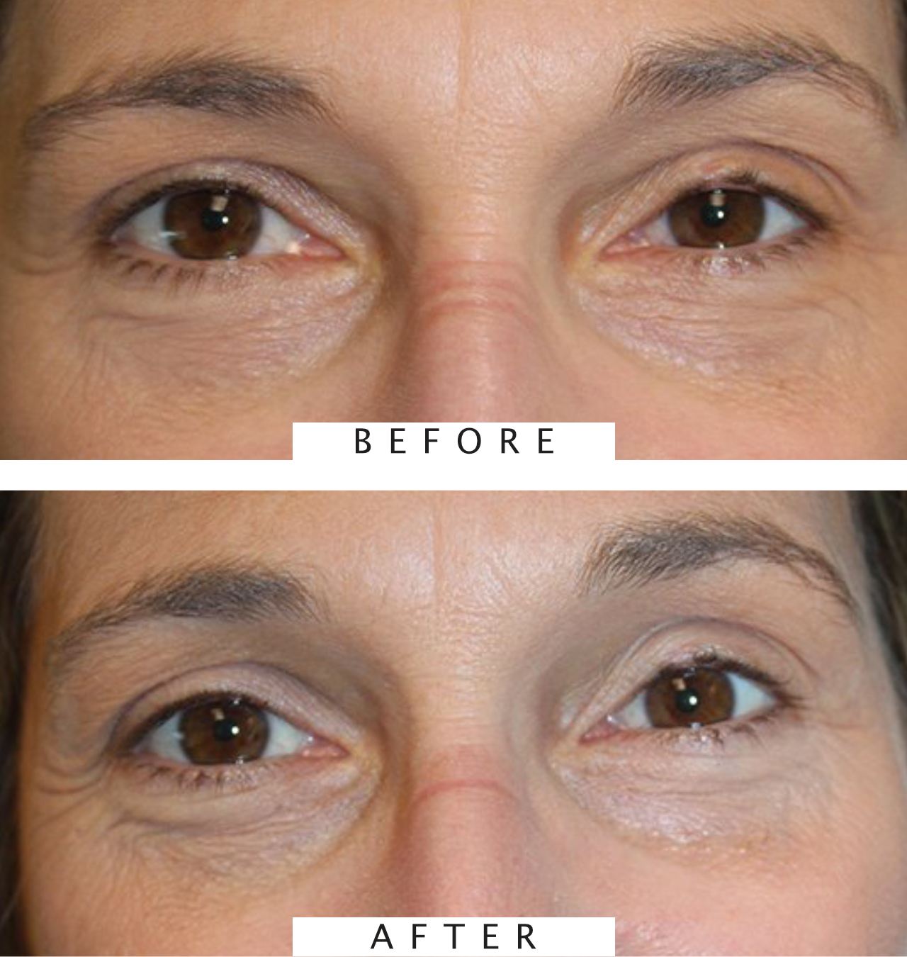 Ptosis Procedure