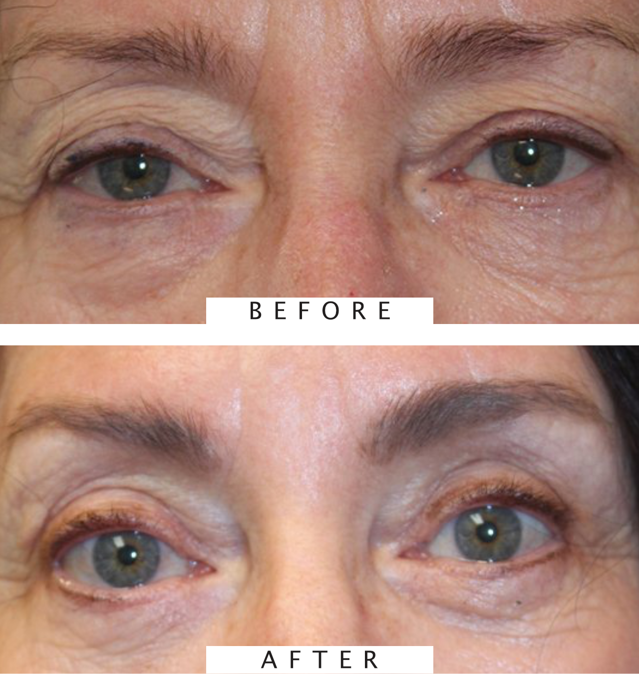 Ptosis Procedure