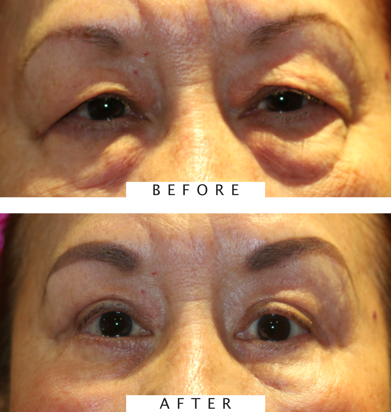 Cosmetic Bilateral Upper & Lower Blepharoplasty