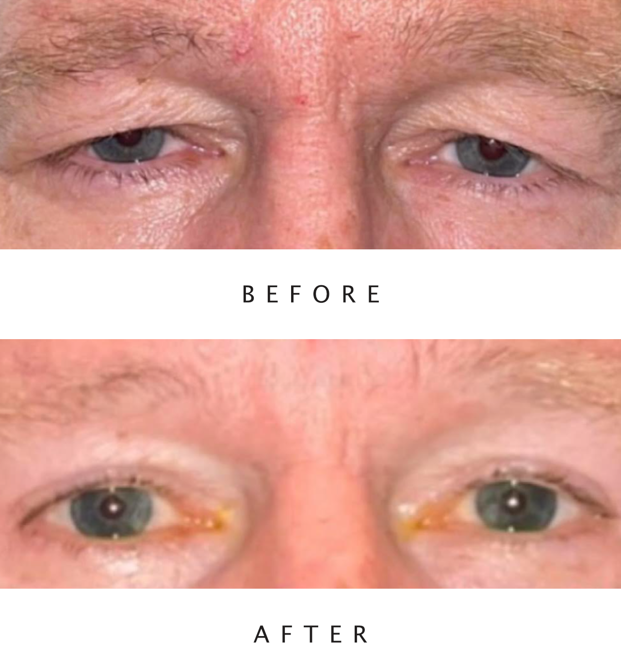 Upper Lid Blepharoplasty