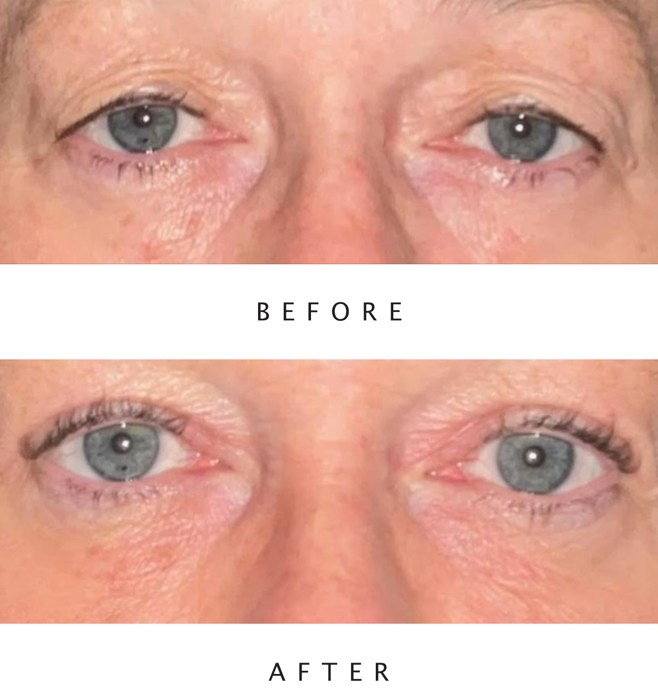 Upper Lid Blepharoplasty