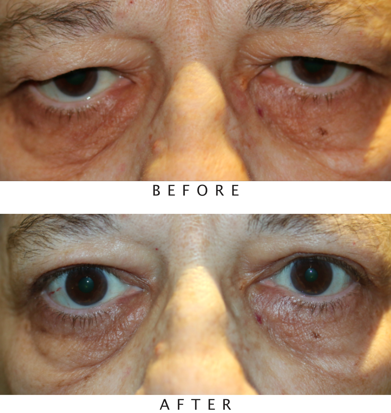 Upper Lid Blepharoplasty