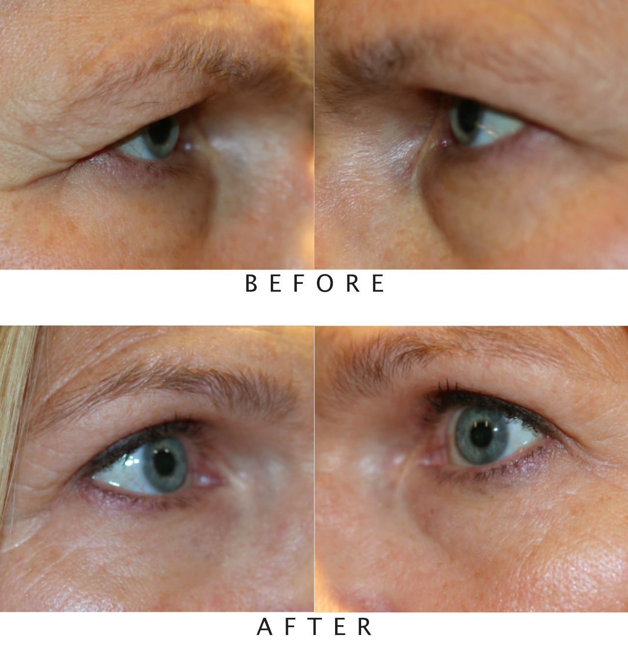 Bilateral Upper Lid Blepharoplasty with Bilateral Browpexy