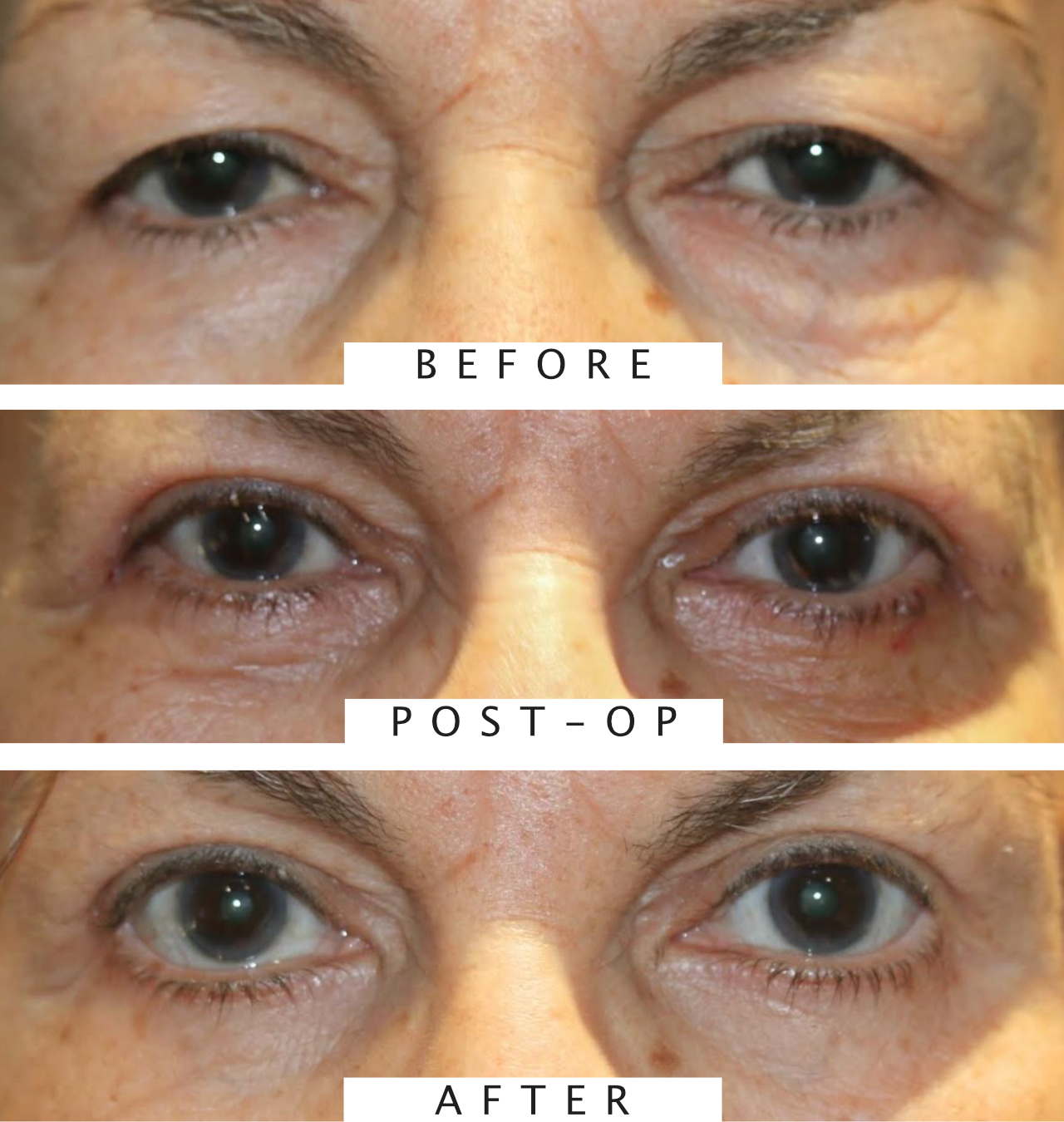 Upper & Lower Eyelid Blepharoplasty with Chemical Peel