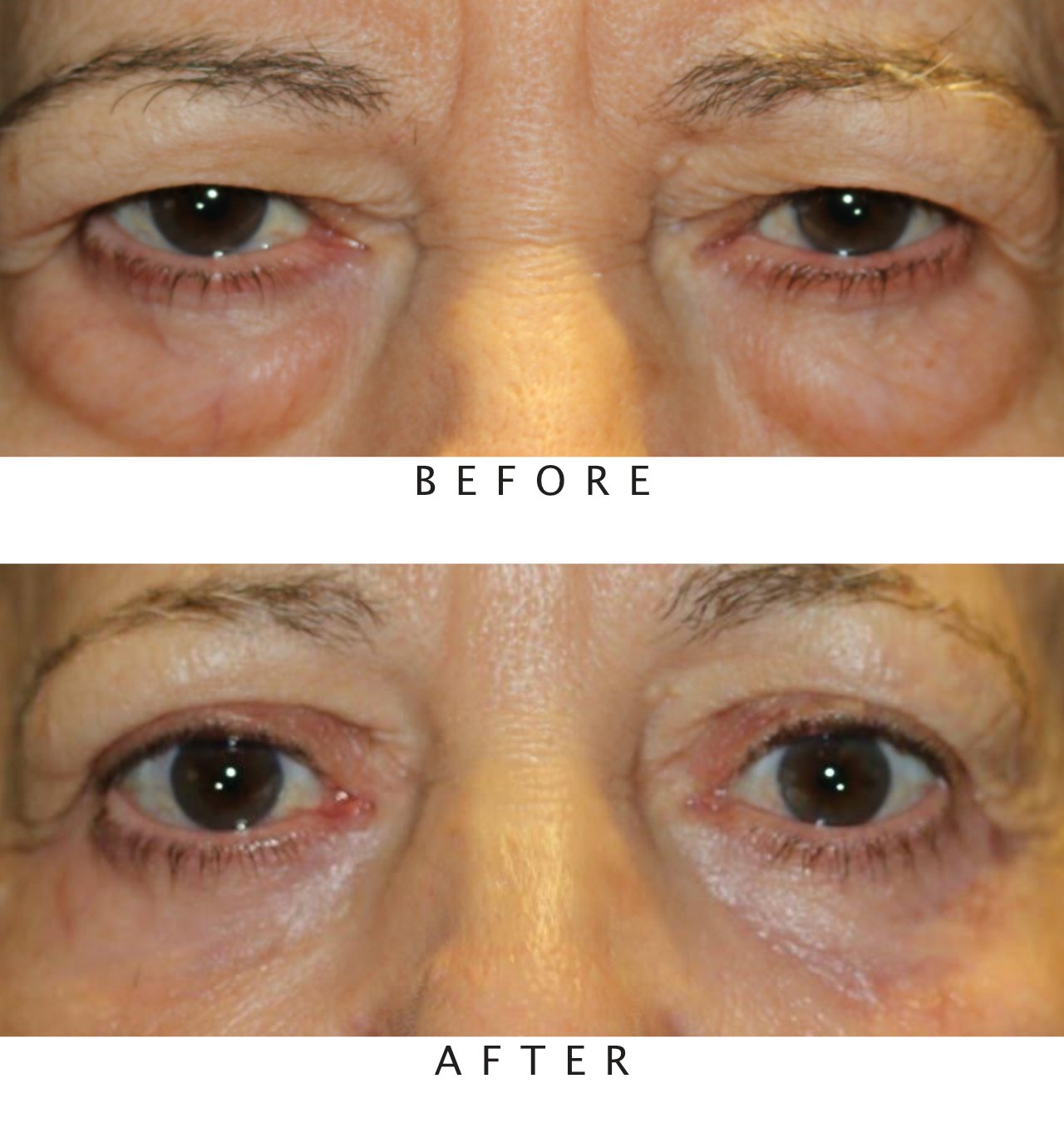 Upper & Lower Eyelid Blepharoplasty with Chemical Peel