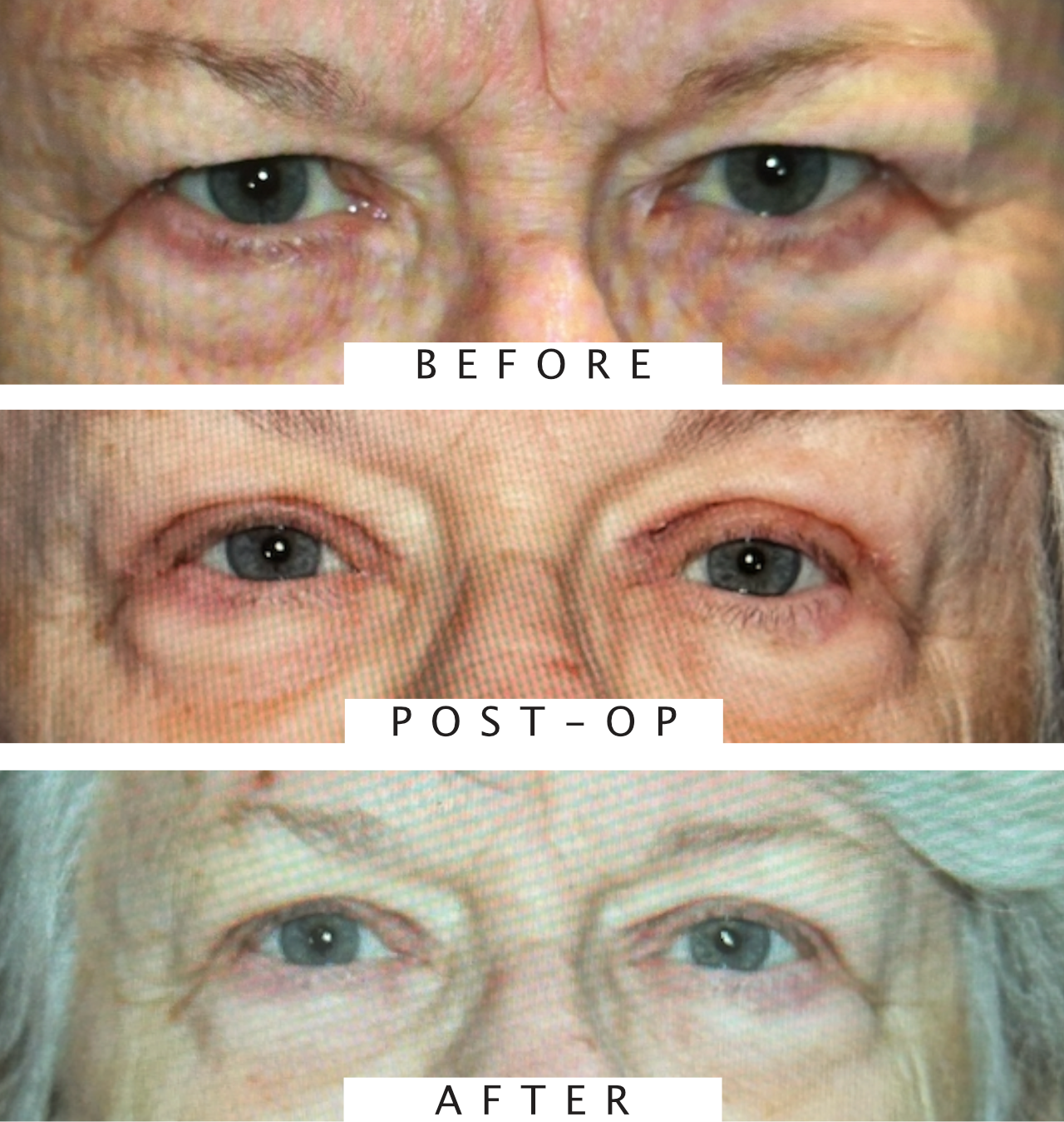 Bilateral Upper Eyelid Blepharoplasty.