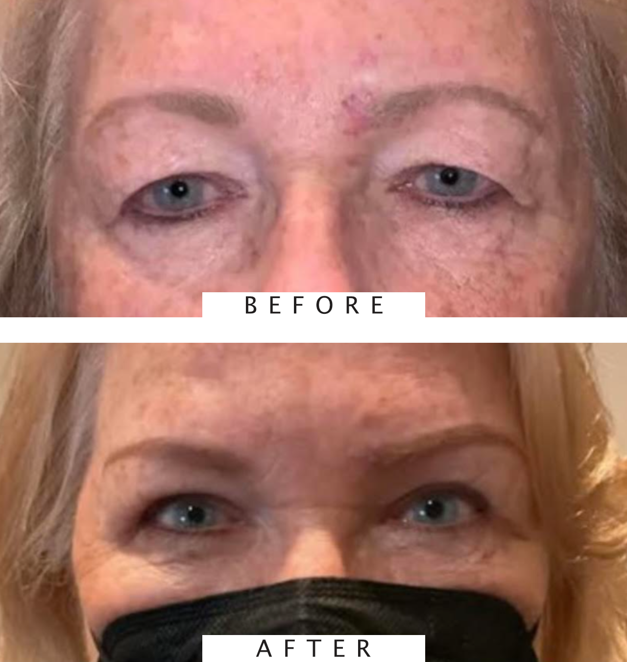 Upper Lid Blepharoplasty