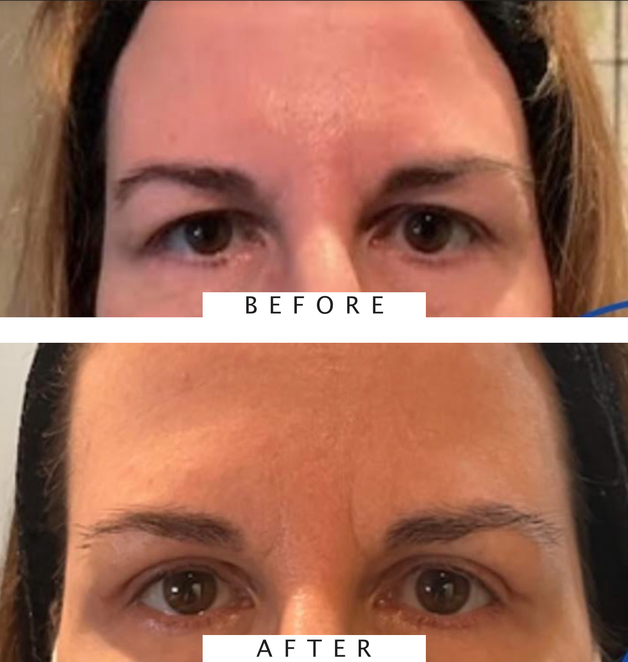 Upper Lid Blepharoplasty