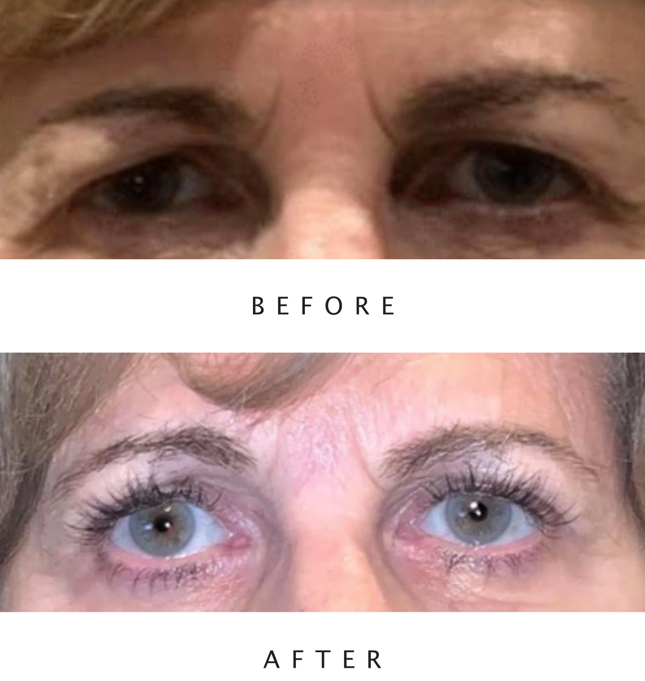 Upper Lid Blepharoplasty