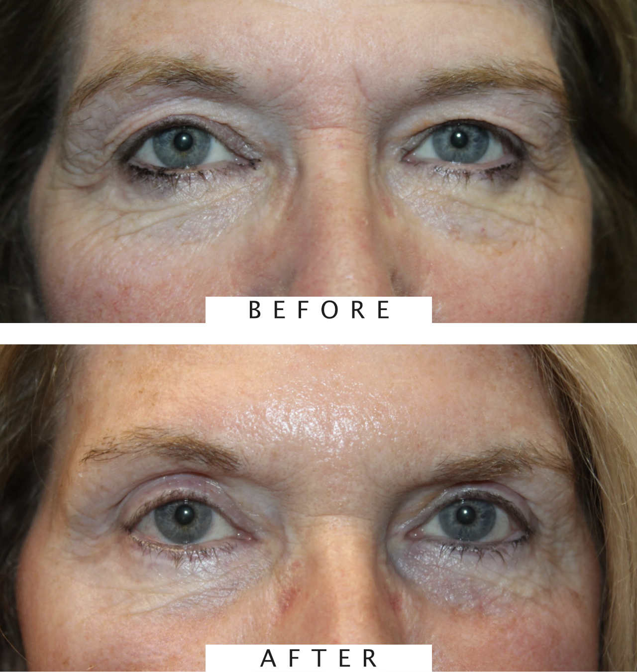 Cosmetic Upper & Lower Blepharoplasty, Botox to Forehead & CO2 Laser Resurfacing to Full Face