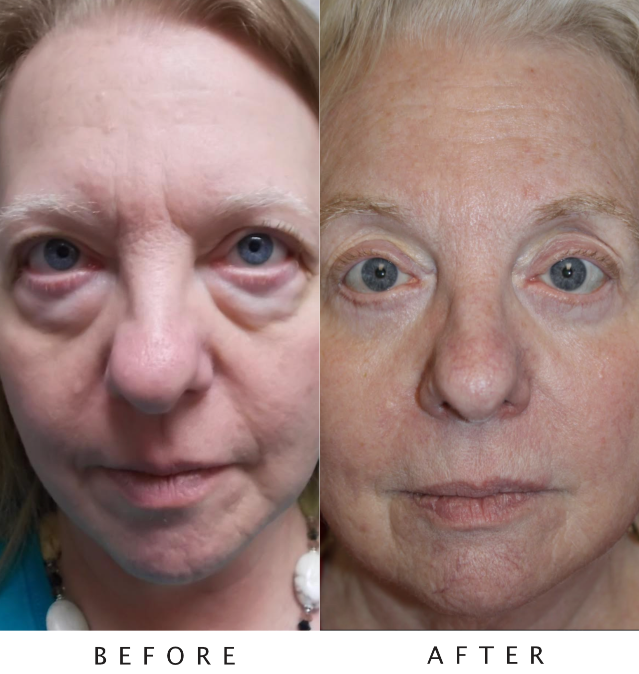 Cosmetic Upper and Lower Blepharoplasty, Bilateral Canthoplasty, Botox & Obagi & Chemical Peels CO2 Laser Resurfacing to Full Face