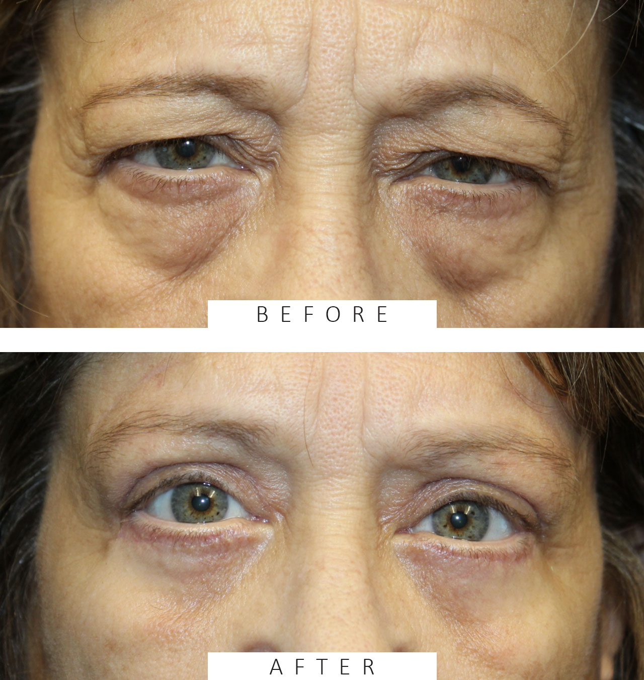 Direct brow ptosis repair, external ptosis repair, lower eyelid blepharoplasty with canthopexy