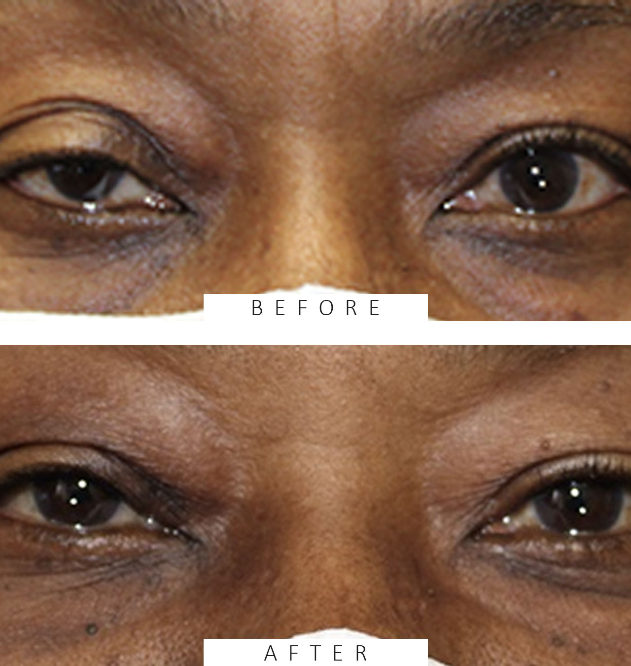 Ptosis repair on Right Eyelid.