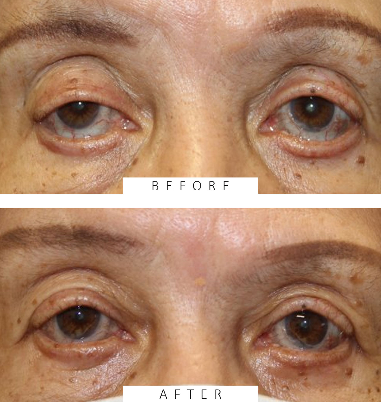 Lower Eyelid Retraction with an Enduragen Graft and Ptosis Repair