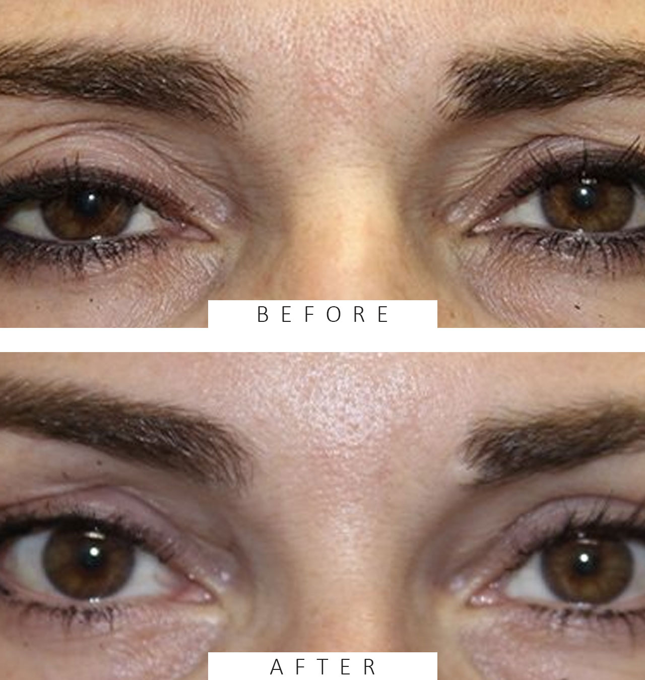 Ptosis Repair