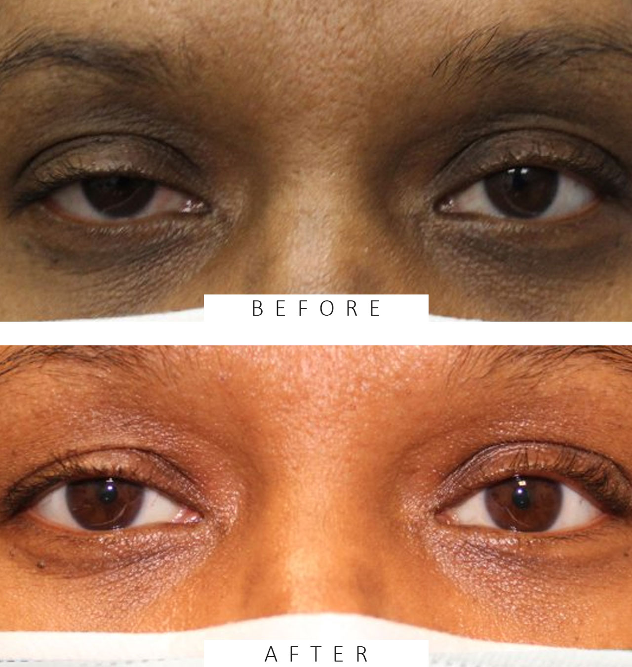 Bilateral Internal Ptosis Repair