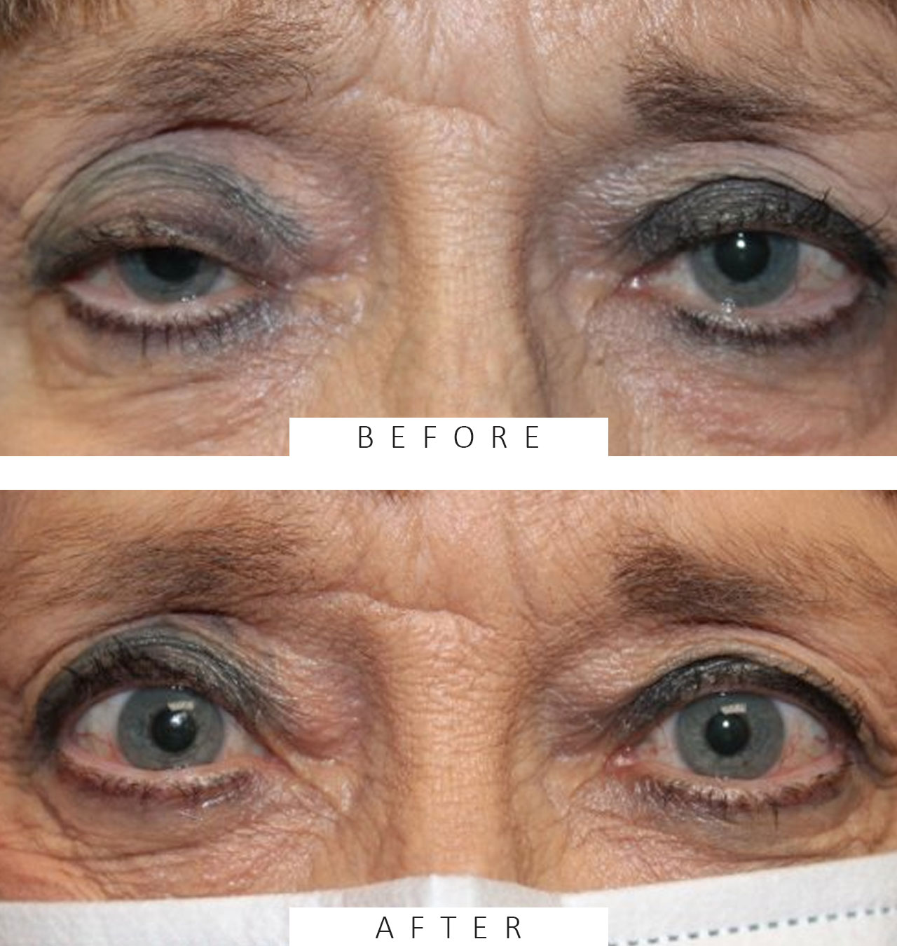 Internal Ptosis Repair of both Eyes