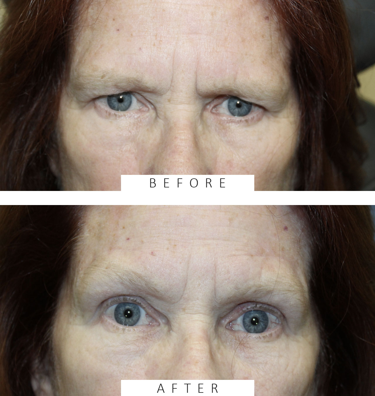 2 months following a direct brow ptosis repair