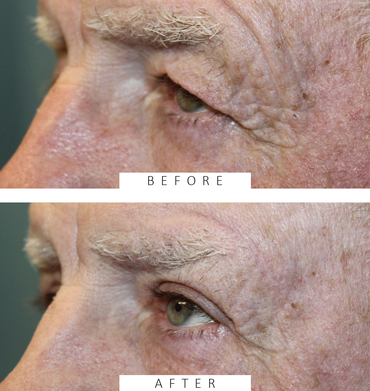 2 months following direct brow ptosis repair, ectropion repair, and upper blepharoplasty