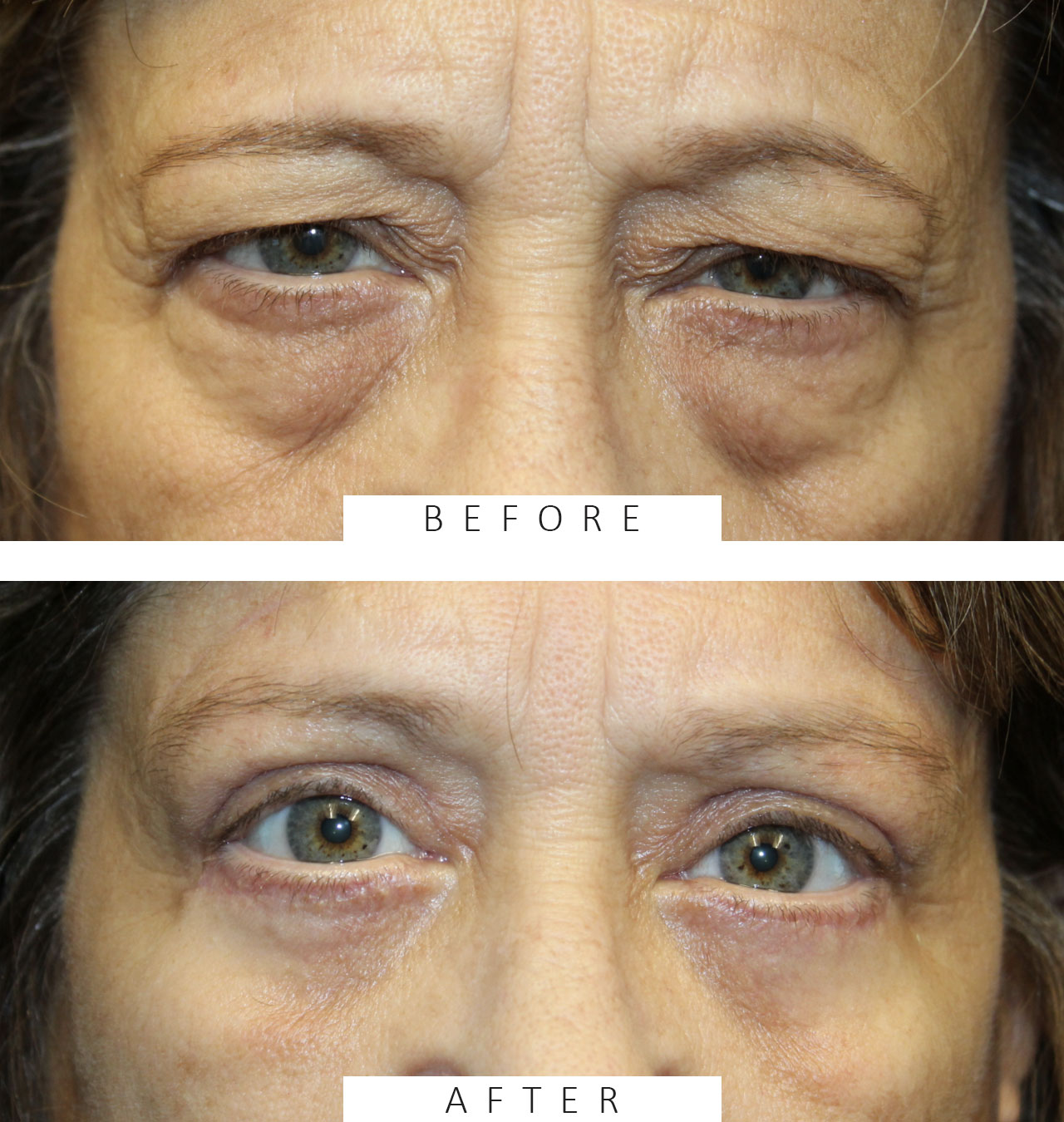 Direct brow ptosis repair, external ptosis repair, lower eyelid blepharoplasty with canthopexy