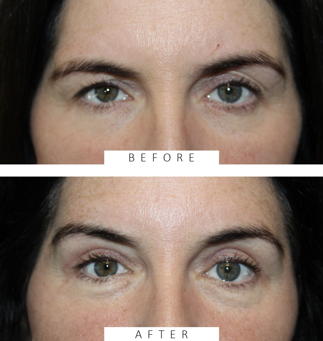 pretrichial brow lift on both sides and upper blepharoplasty of the right side.