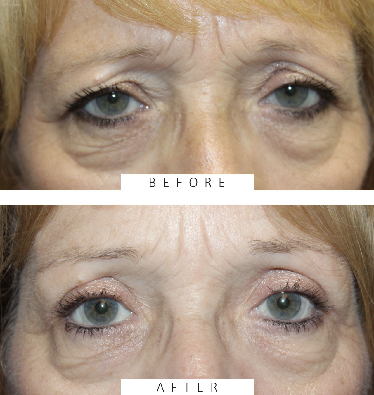 Direct Brow Ptosis Repair and Upper Blepharoplasty