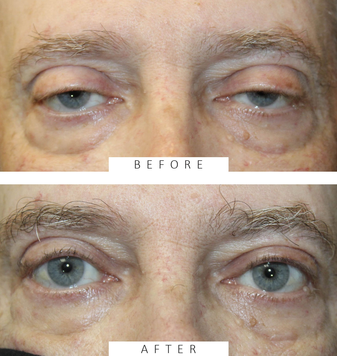 External Ptosis Repair