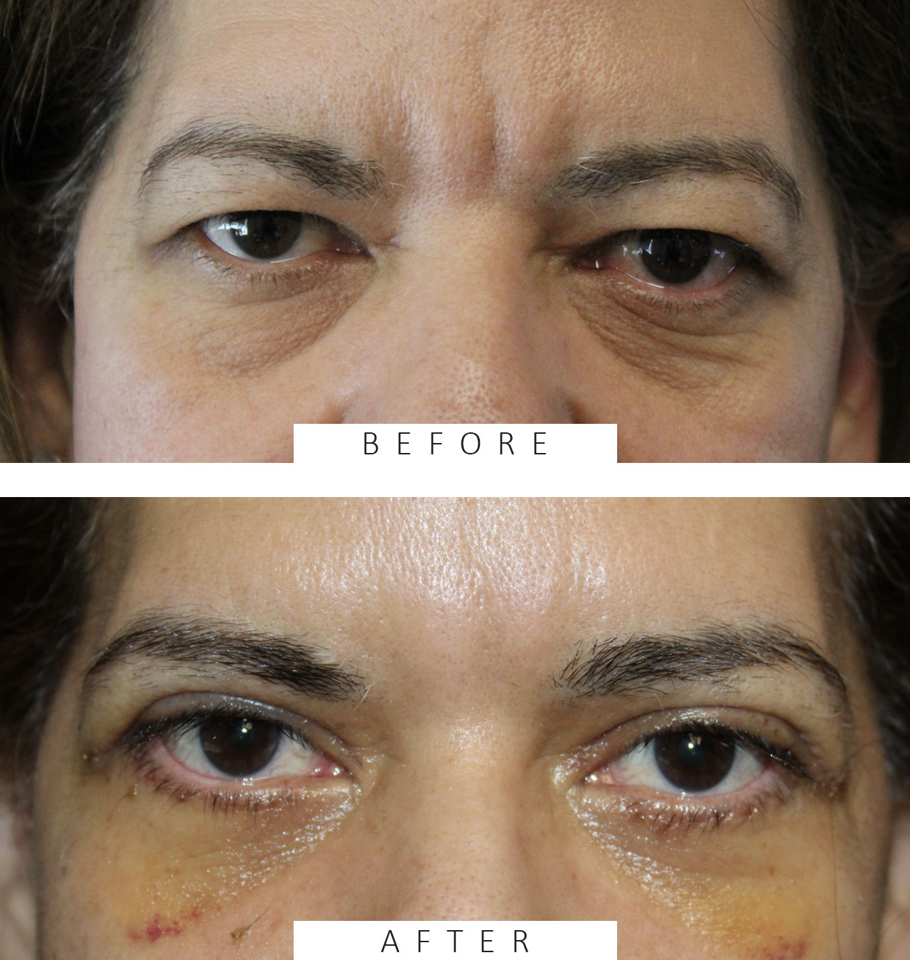 1 week following upper and lower blepharoplasty with skin pinch, canthopexy, and fat transposition